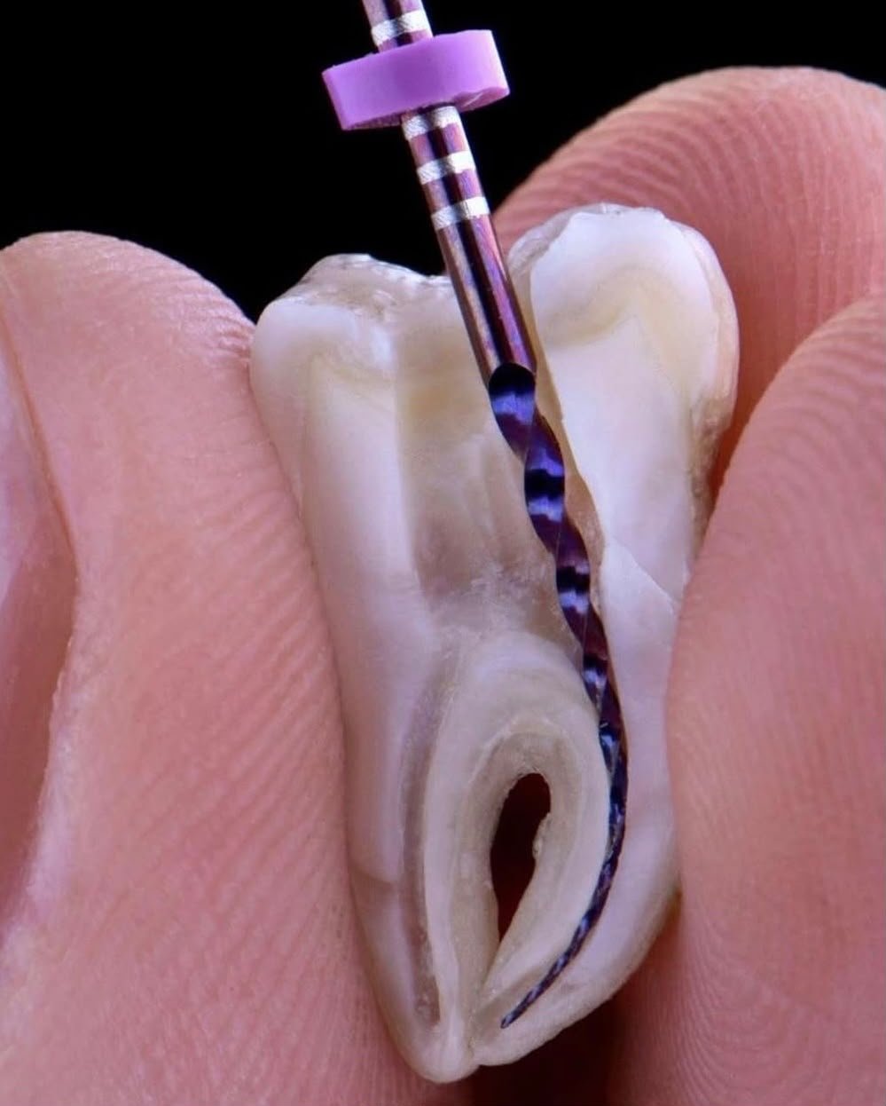 Tratamento de canal — endodontia