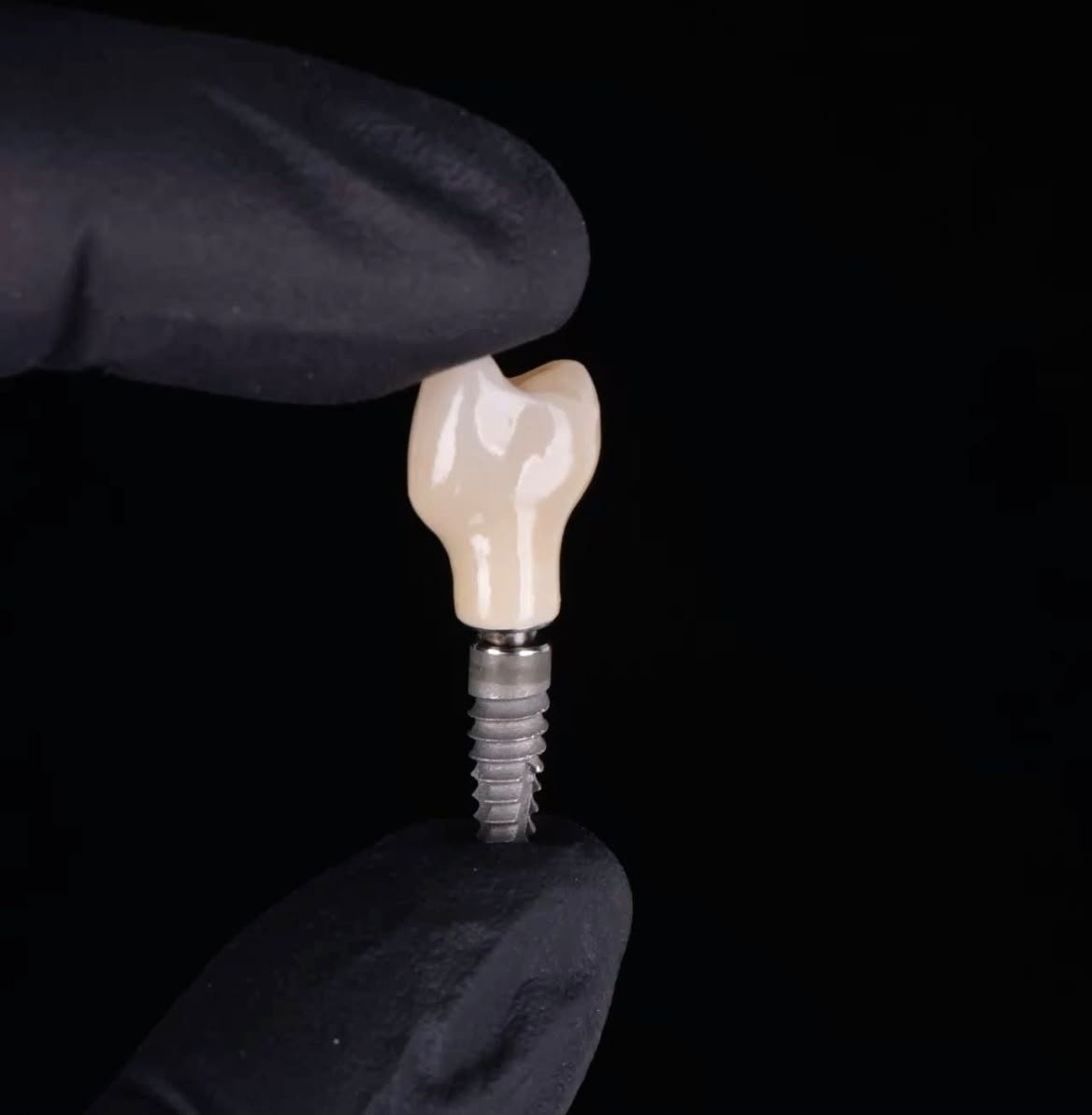 Implante dentário — coroa sobre pino de titânio
