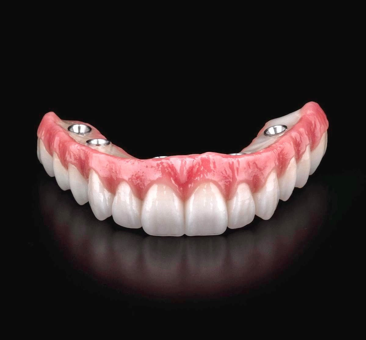 Prótese protocolo — arcada completa fixa sobre implantes